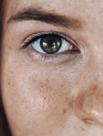 Депигментираща терапия